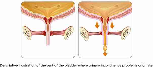 Reflex incontinence outlet